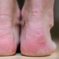 Expert's Guide: Understanding and Managing Common Foot Disorders