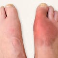 The Impact of Foot Deformities on Quality of Life