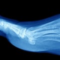 Expert Insights: When to Get an X-Ray for Ankle Pain