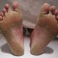 Expert Insights: Common Foot Diseases and Conditions