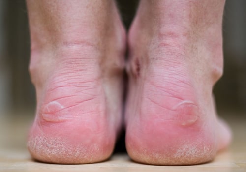 Expert's Guide: Understanding and Managing Common Foot Disorders