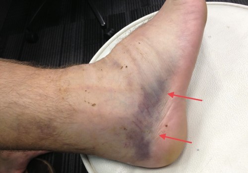 Ankle Instability: Understanding the Causes, Symptoms, and Treatment