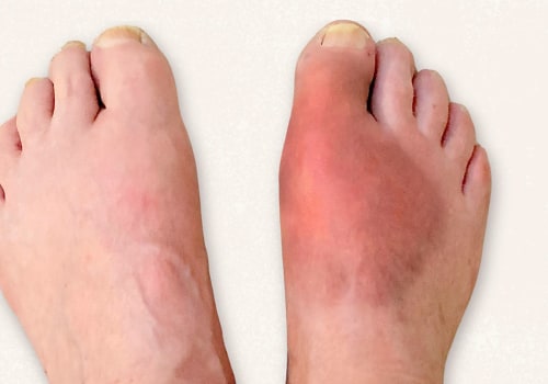 The Impact of Foot Deformities on Quality of Life