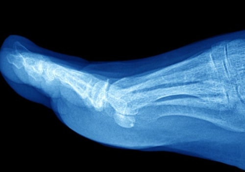 Expert Insights: When to Get an X-Ray for Ankle Pain