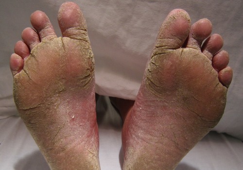 Expert Insights: Common Foot Diseases and Conditions